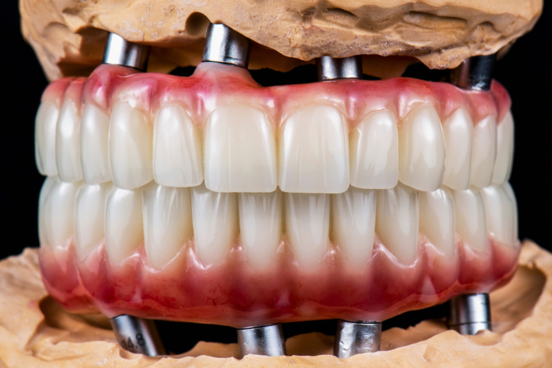 All on X Dental Implants in San Luis Obispo