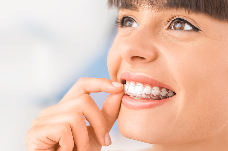 Clear Aligner Therapy in San Luis Obispo