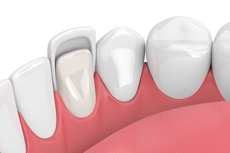 Dental Veneers in San Luis Obispo