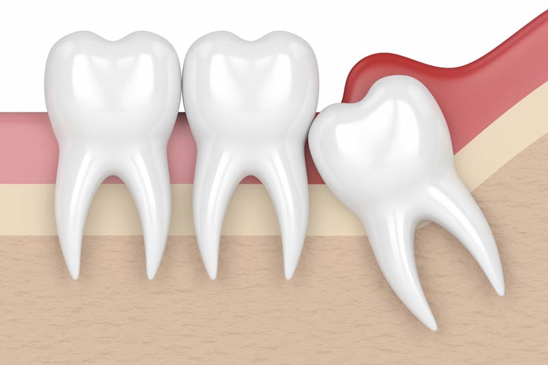 Wisdom Tooth Removal in San Luis Obispo